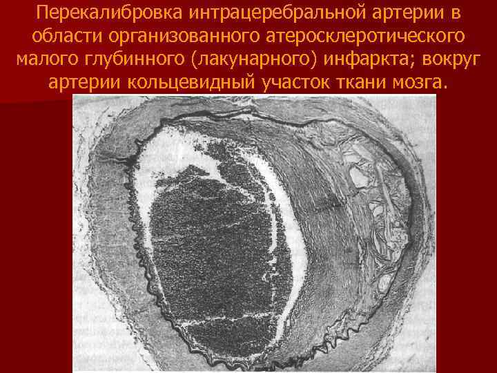 Перекалибровка интрацеребральной артерии в области организованного атеросклеротического малого глубинного (лакунарного) инфаркта; вокруг артерии кольцевидный