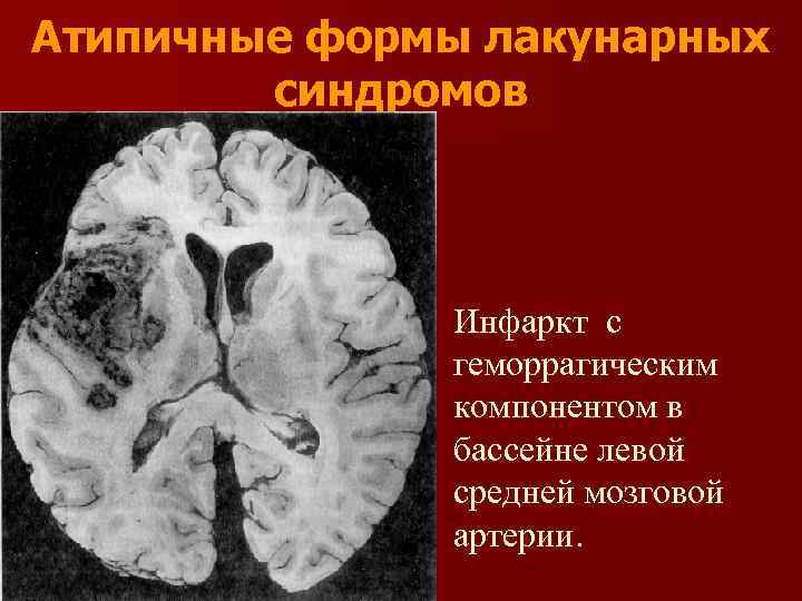 Атипичные формы лакунарных синдромов Инфаркт с геморрагическим компонентом в бассейне левой средней мозговой артерии.