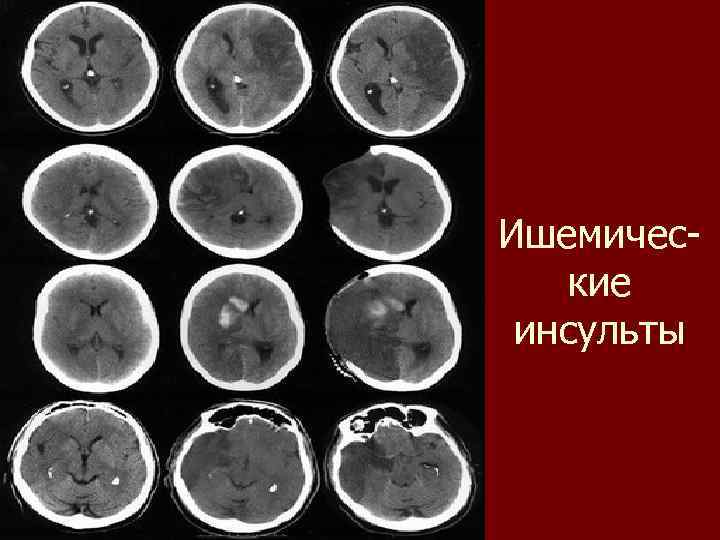 Ишемические инсульты 
