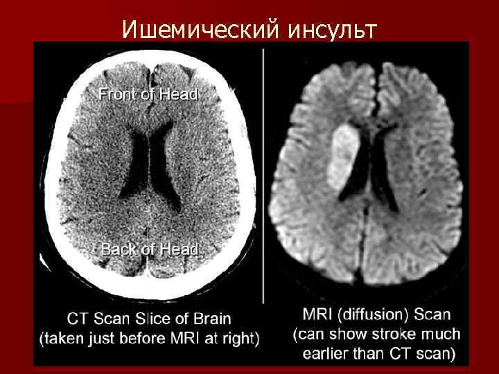 Ишемический инсульт 