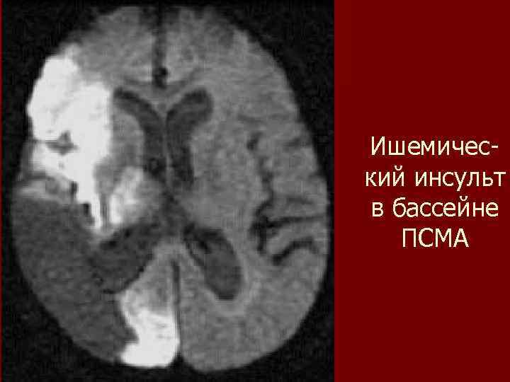 Ишемический инсульт в бассейне ПСМА 