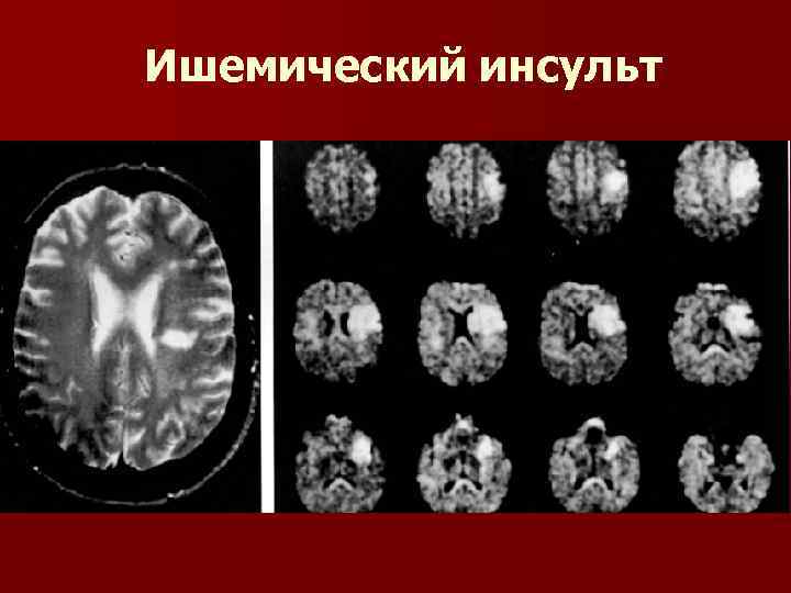 Ишемический инсульт 