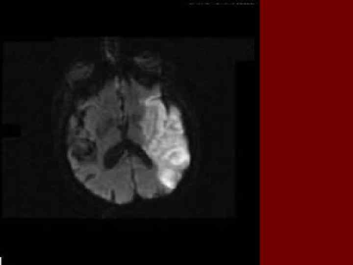 n Ишемичес-кий инсульт 