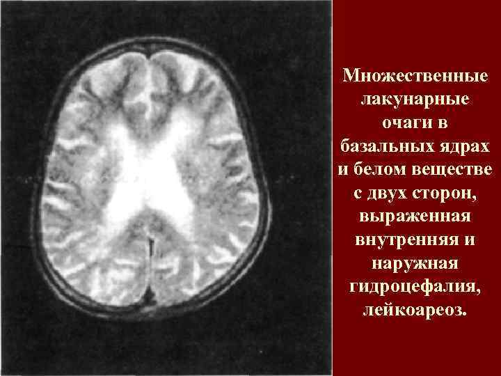 Множественные лакунарные очаги в базальных ядрах и белом веществе с двух сторон, выраженная внутренняя