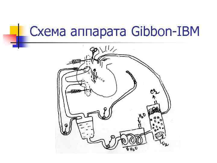 Схема аппарата Gibbon-IBM 