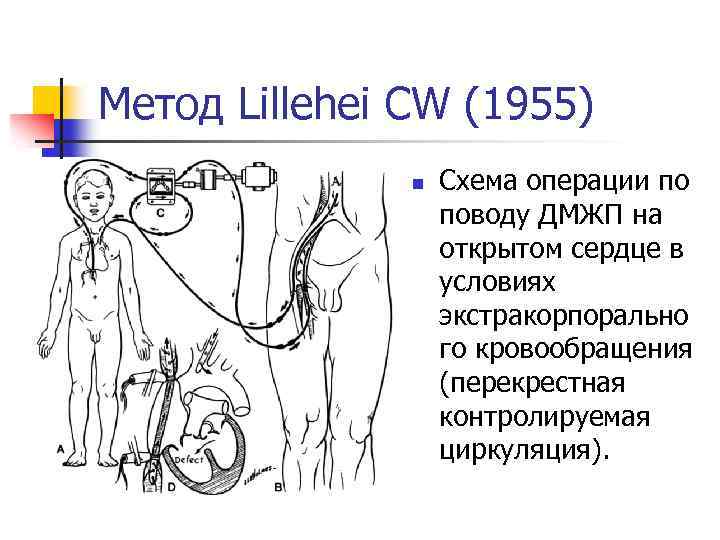 Метод Lillehei CW (1955) n Схема операции по поводу ДМЖП на открытом сердце в