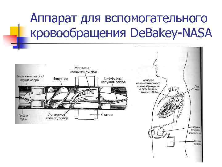 Аппарат для вспомогательного кровообращения De. Bakey-NASA 