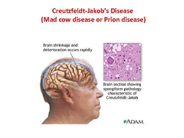 Creutzfeldt-Jakob’s Disease (Mad cow disease or Prion disease) 