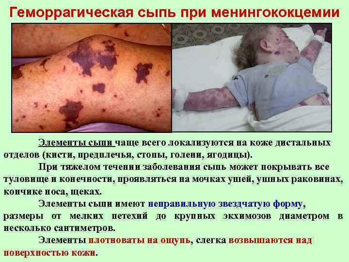 Геморрагическая сыпь при менингококцемии Элементы сыпи чаще всего локализуются на коже дистальных отделов (кисти,