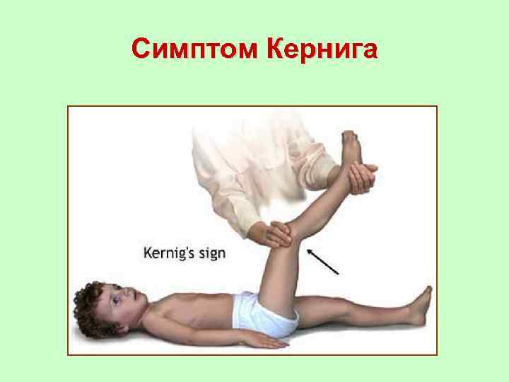 Симптом Кернига 