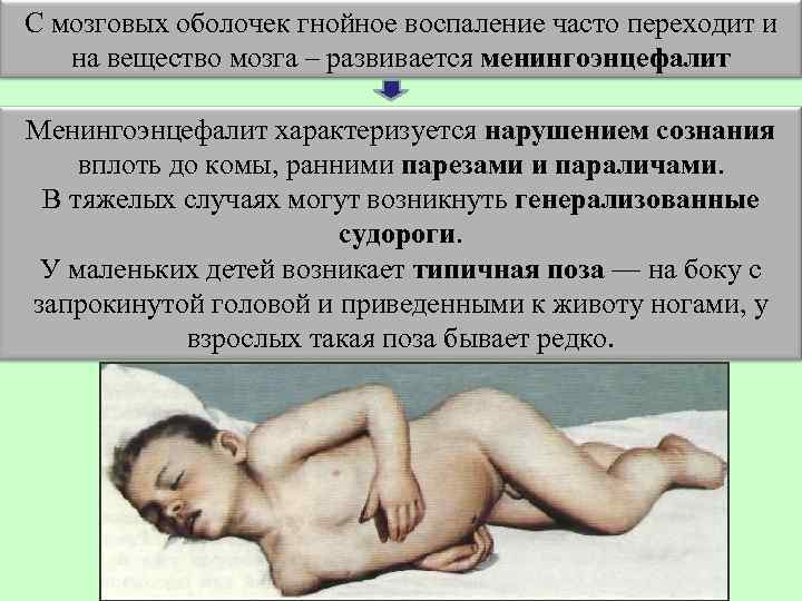 С мозговых оболочек гнойное воспаление часто переходит и на вещество мозга – развивается менингоэнцефалит