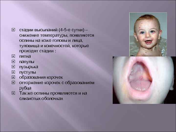  стадии высыпаний (4 -5 -е сутки) – снижение температуры, появляются оспины на коже