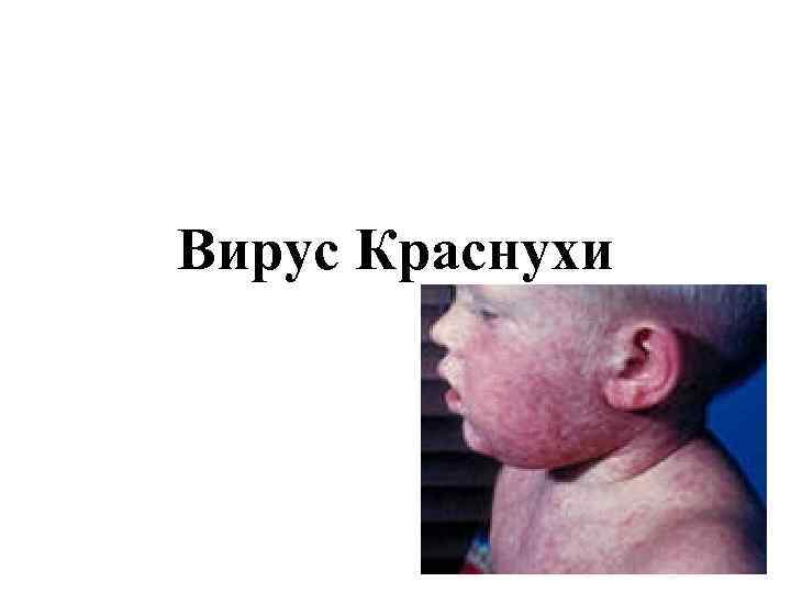 Вирус Краснухи 