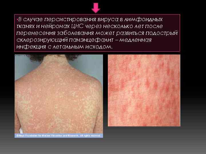  • В случае персистирования вируса в лимфоидных тканях и нейронах ЦНС через несколько