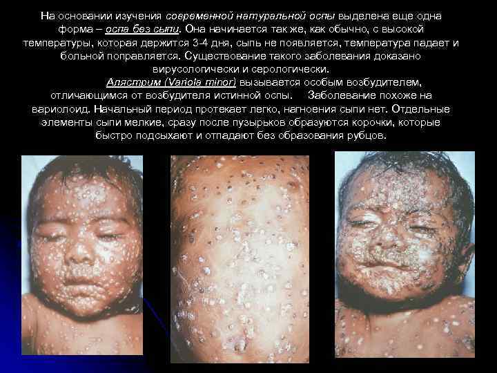 На основании изучения современной натуральной оспы выделена еще одна форма – оспа без сыпи.