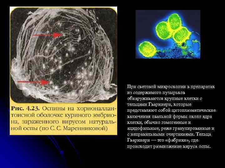 При световой микроскопии в препаратах из содержимого пузырьков обнаруживаются крупные клетки с тельцами Гварниери,