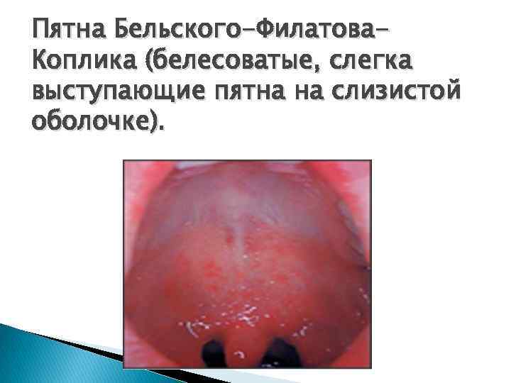 Пятна Бельского-Филатова. Коплика (белесоватые, слегка выступающие пятна на слизистой оболочке). 