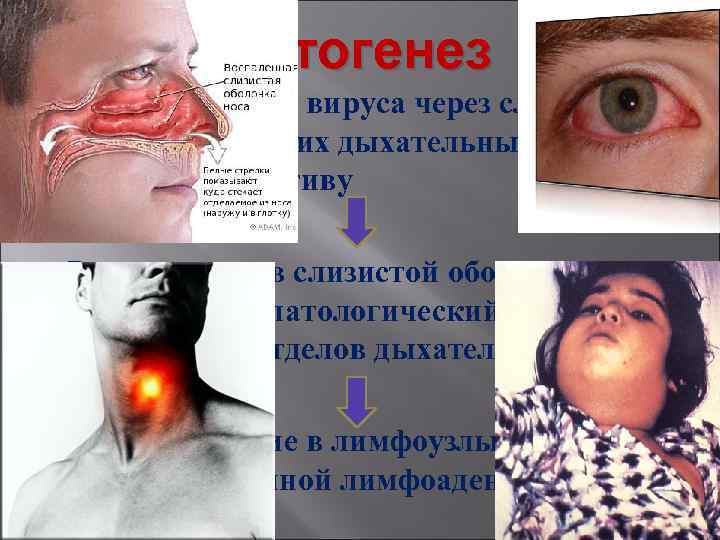 Патогенез Ø Проникновение вируса через слизистые оболочки верхних дыхательных путей, реже, конъюнктиву Ø Размножение