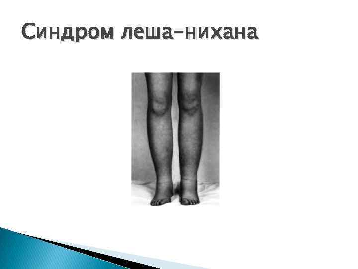 Синдром леша-нихана 