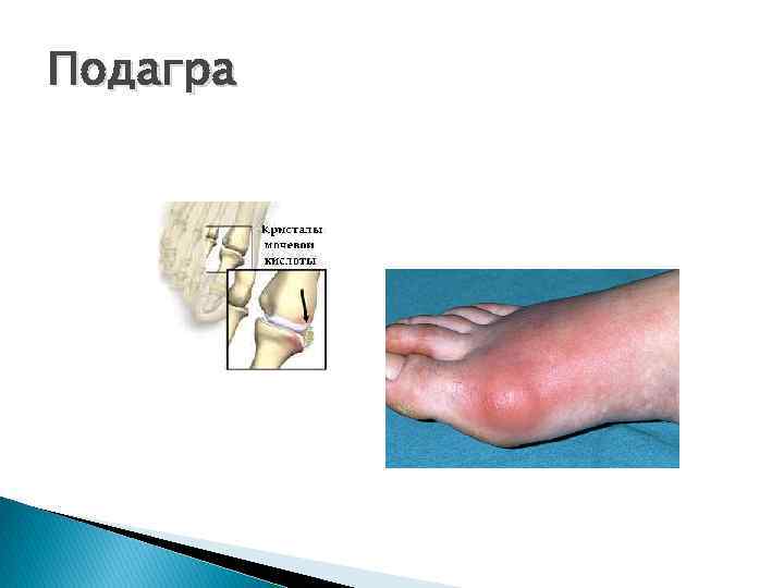 Подагра 