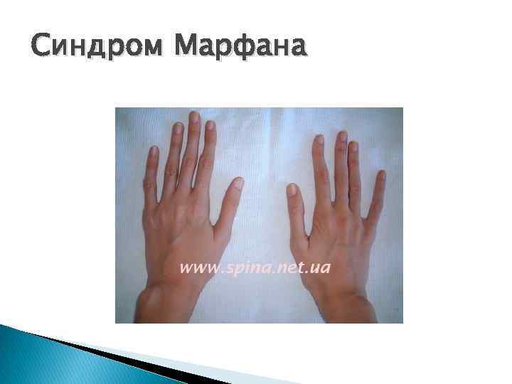 Синдром Марфана 