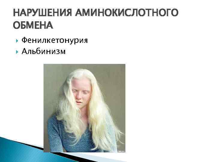 НАРУШЕНИЯ АМИНОКИСЛОТНОГО ОБМЕНА Фенилкетонурия Альбинизм 