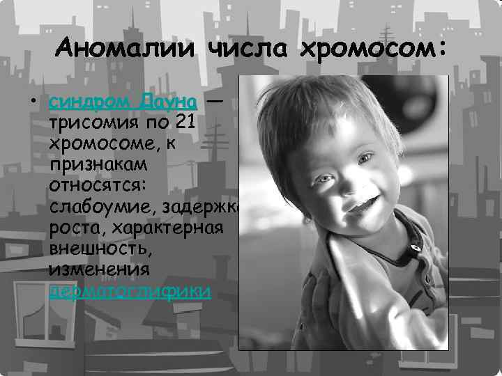 Аномалии числа хромосом: • синдром Дауна — Дауна трисомия по 21 хромосоме, к признакам