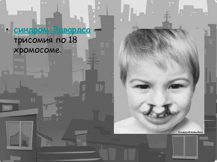 • синдром Эдвардса — трисомия по 18 хромосоме. 
