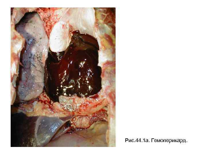 Рис. 44. 1 а. Гемоперикард. 