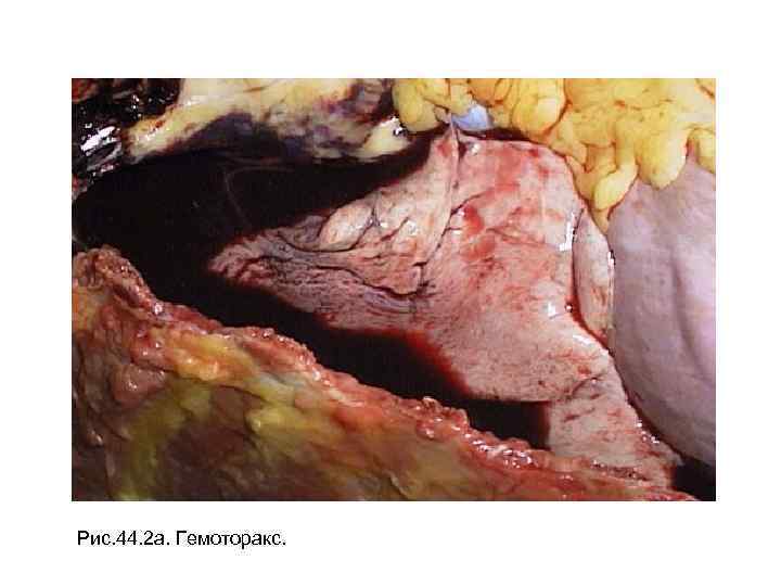 Рис. 44. 2 а. Гемоторакс. 