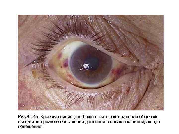 Рис. 44. 4 а. Кровоизлияние per rhexin в конъюнктивальной оболочке вследствие резкого повышения давления