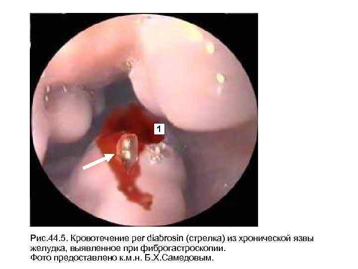 1 Рис. 44. 5. Кровотечение per diabrosin (стрелка) из хронической язвы желудка, выявленное при