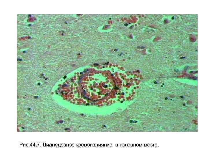 Рис. 44. 7. Диапедезное кровоизлияние в головном мозге. 