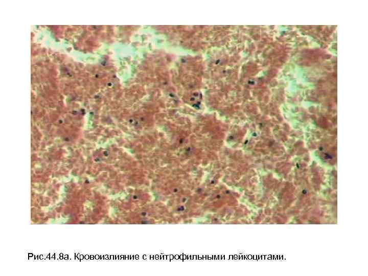 Рис. 44. 8 а. Кровоизлияние с нейтрофильными лейкоцитами. 