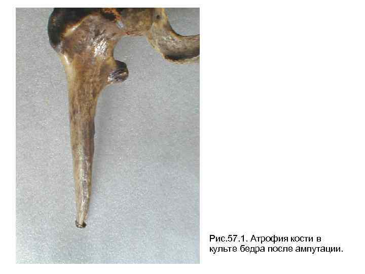 Рис. 57. 1. Атрофия кости в культе бедра после ампутации. 