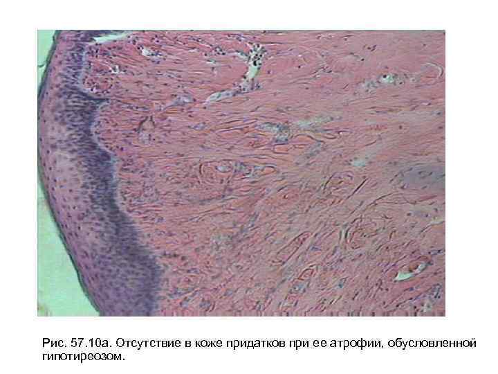 Рис. 57. 10 а. Отсутствие в коже придатков при ее атрофии, обусловленной гипотиреозом. 