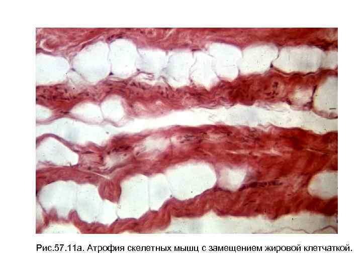 Рис. 57. 11 а. Атрофия скелетных мышц с замещением жировой клетчаткой. 