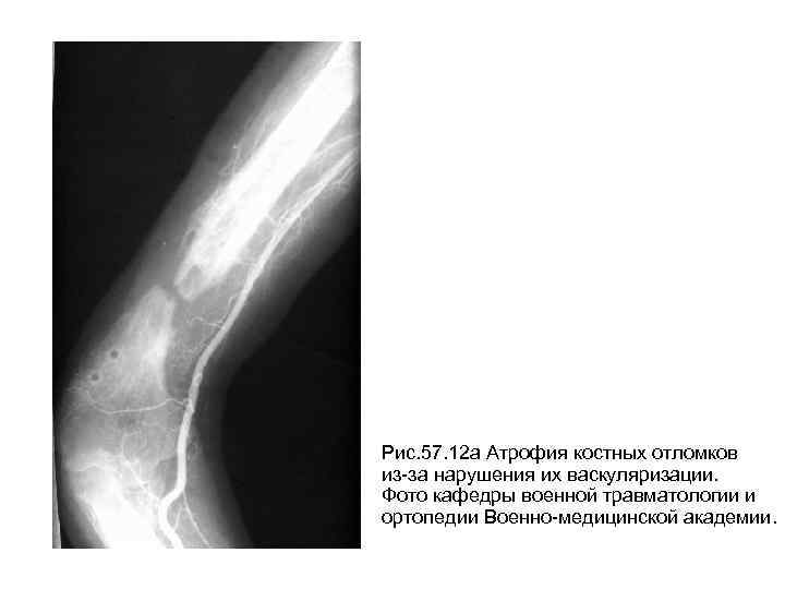 Рис. 57. 12 а Атрофия костных отломков из-за нарушения их васкуляризации. Фото кафедры военной