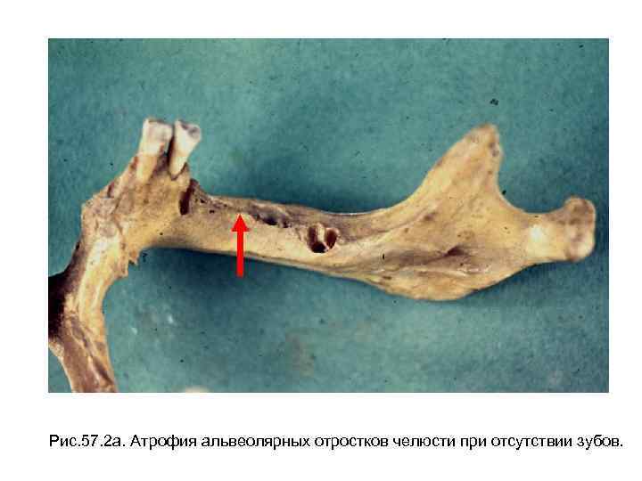 Рис. 57. 2 а. Атрофия альвеолярных отростков челюсти при отсутствии зубов. 