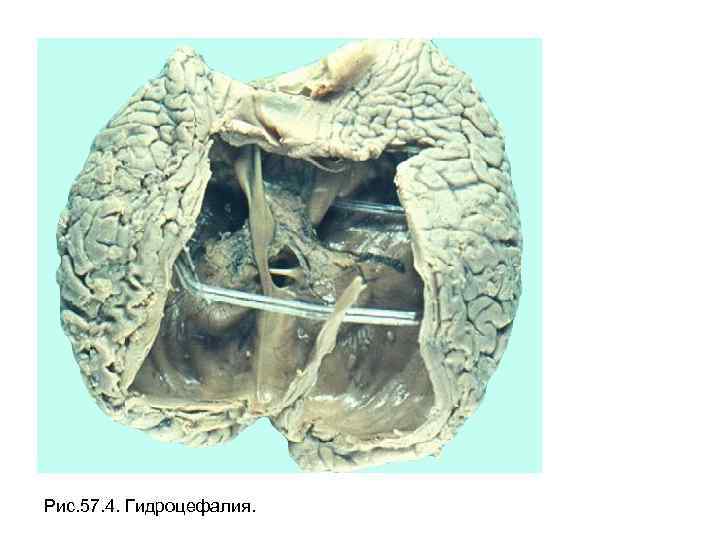 Рис. 57. 4. Гидроцефалия. 