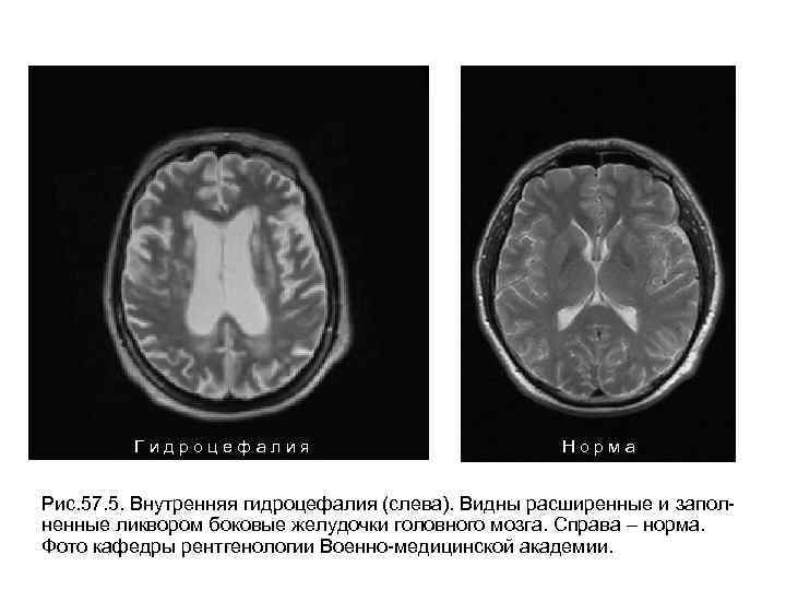 Гидроцефалия Норма Рис. 57. 5. Внутренняя гидроцефалия (слева). Видны расширенные и заполненные ликвором боковые