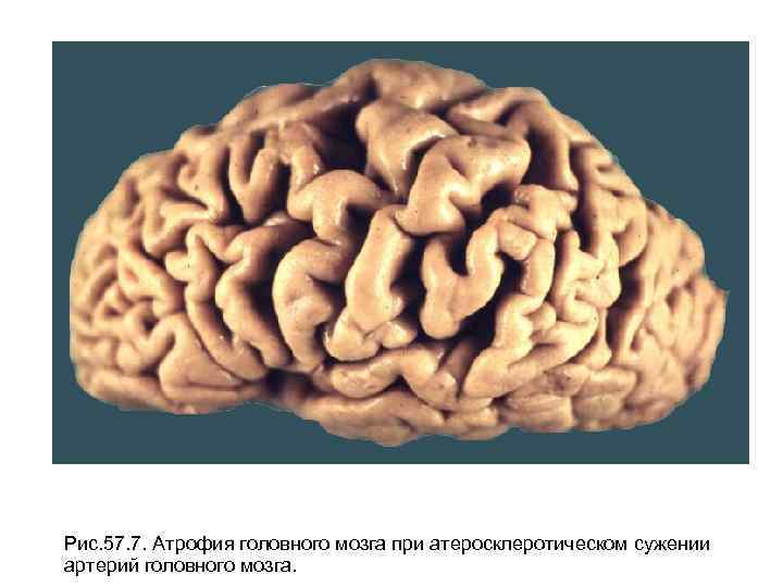 Рис. 57. 7. Атрофия головного мозга при атеросклеротическом сужении артерий головного мозга. 