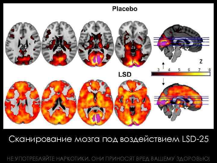 Сканирование мозга под воздействием LSD-25 НЕ УПОТРЕБЛЯЙТЕ НАРКОТИКИ. ОНИ ПРИНОСЯТ ВРЕД ВАШЕМУ ЗДОРОВЬЮ! 