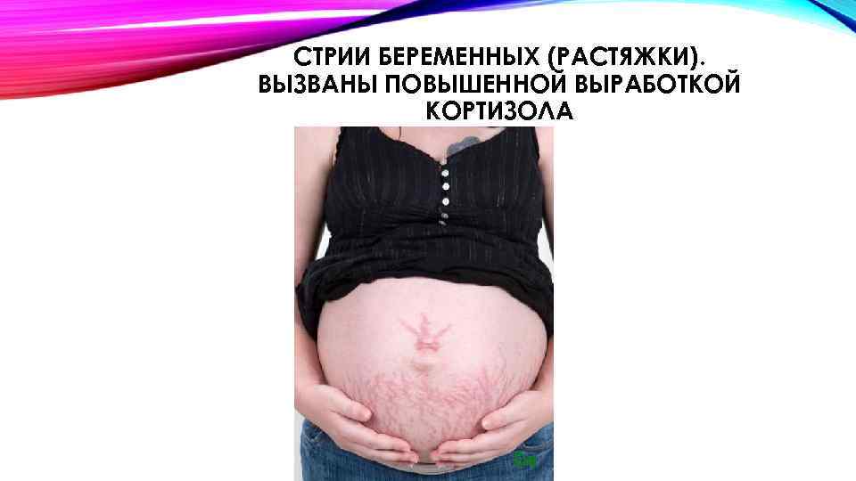 СТРИИ БЕРЕМЕННЫХ (РАСТЯЖКИ). ВЫЗВАНЫ ПОВЫШЕННОЙ ВЫРАБОТКОЙ КОРТИЗОЛА 
