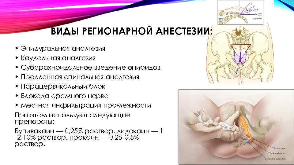 ВИДЫ РЕГИОНАРНОЙ АНЕСТЕЗИИ: • Эпидуральная аналгезия • Каудальная аналгезия • Субарахноидальное введение опиоидов •