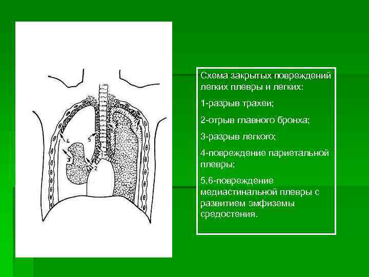Схема закрытых повреждений легких плевры и легких: 1 разрыв трахеи; 2 отрыв главного бронха;