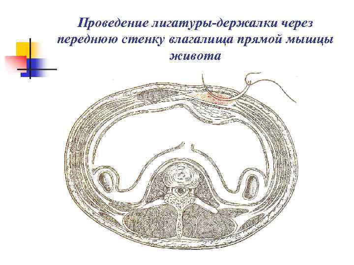 Проведение лигатуры-держалки через переднюю стенку влагалища прямой мышцы живота 