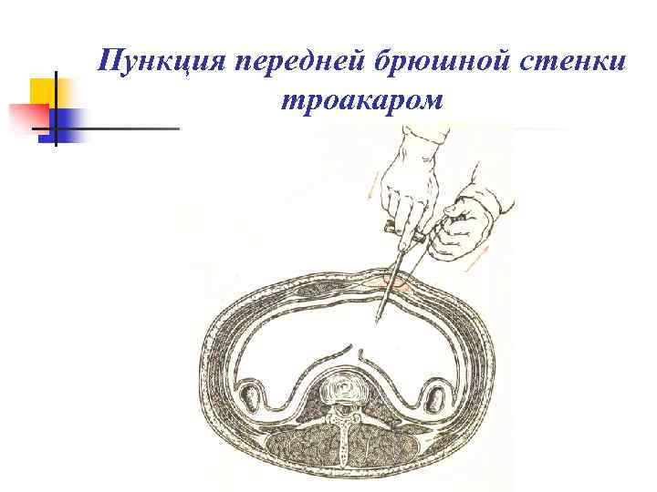 Пункция передней брюшной стенки троакаром 
