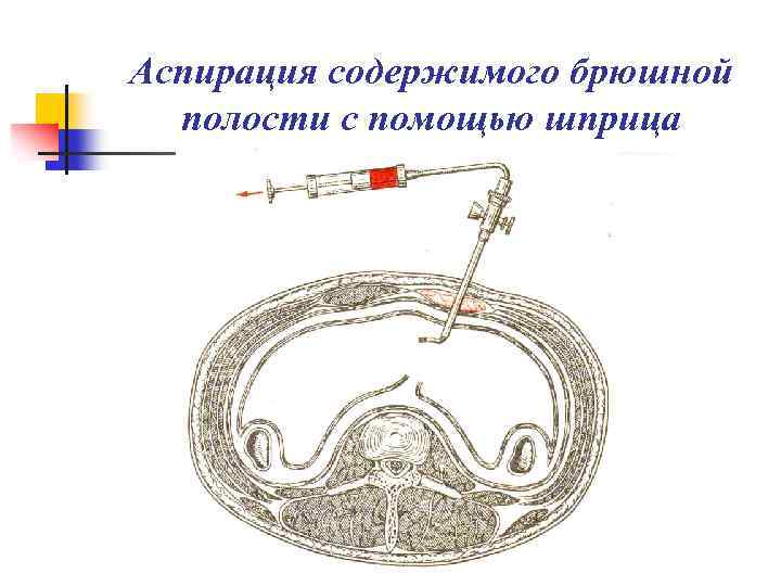 Аспирация содержимого брюшной полости с помощью шприца 