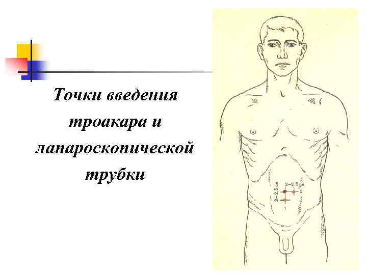 Точки введения троакара и лапароскопической трубки 